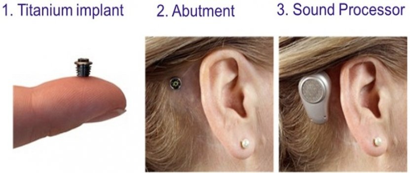 BAHA-Bone-Anchored-Hearing-Aids.jpg