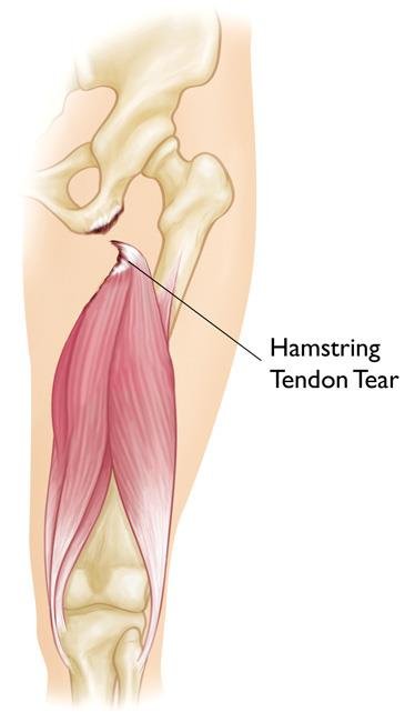 Hamstring tear.jpg