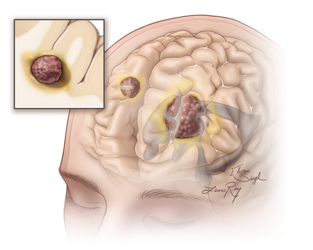 brain-metastasis-Fig_1.jpeg