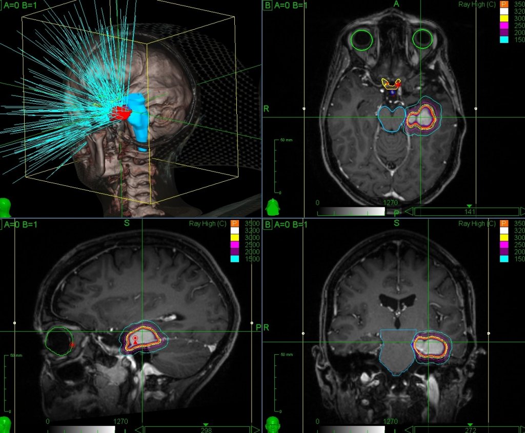 SRS-Meningioma.jpeg