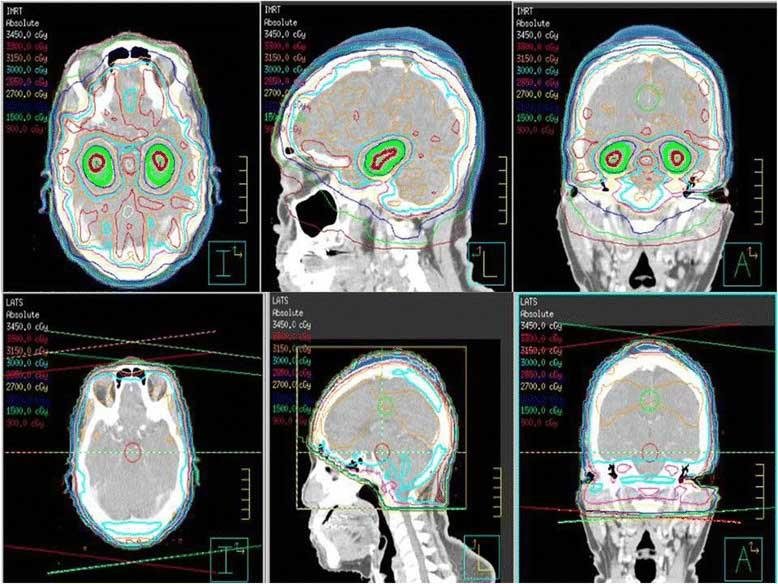 whole-brain-radiation-therapy-avoids-hippocampus-vs-standard-radiation-enalrge.jpeg