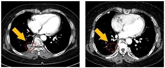 Lung_CT_scan_image_lobe_tumor_lesion_21mm___10mm.jpg