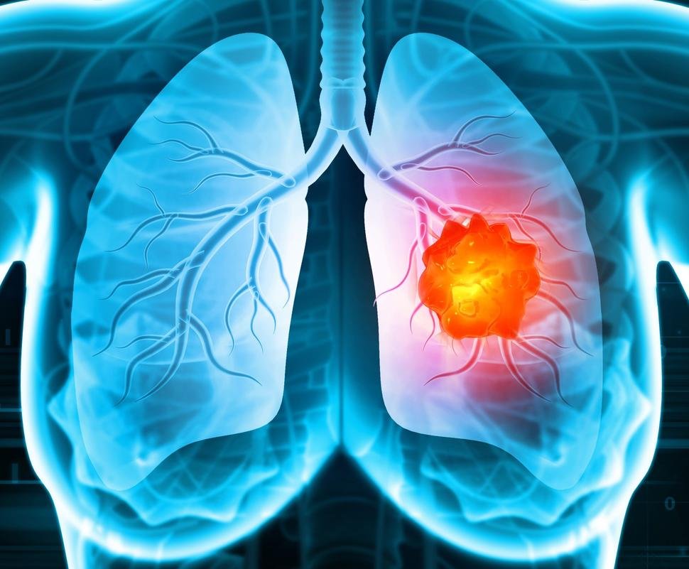 lung tumor illustration.jpg