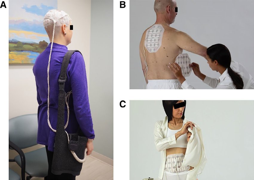 Example-diagrams-of-patients-with-the-tumor-treating-fields-device-A-A-patient-with.jpg