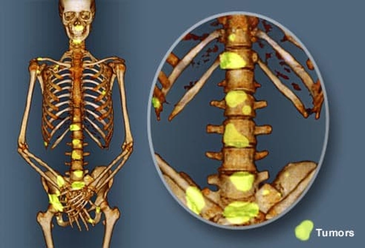 princ_rm_illustraton_of_pet_scan_of_bone_metastasis.png