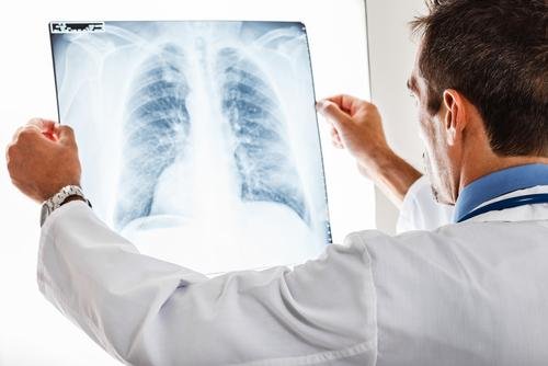 lung-cancer-lawsuit-lawyer-how-quickly-does-lung-cancer-progress.jpg
