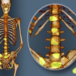 princ_rm_illustraton_of_pet_scan_of_bone_metastasis.png
